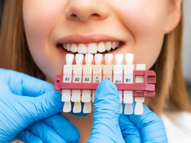 Estética Dental